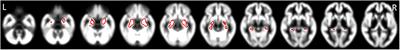 Possibility of Enlargement in Left Medial Temporal Areas Against Cerebral Amyloid Deposition Observed During Preclinical Stage